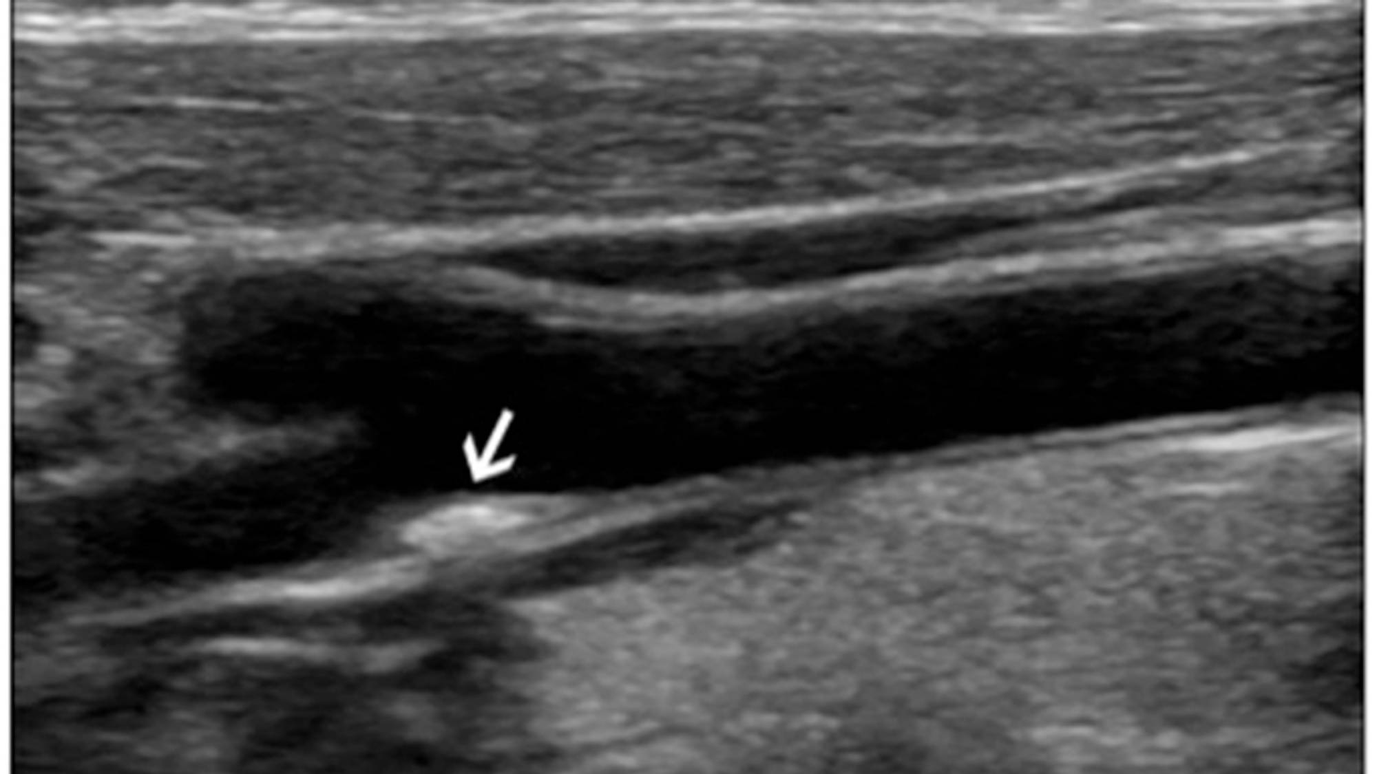 Бляшка в вене. Атеросклеротическая бляшка УЗИ. Пристеночный тромб УЗИ. Атеросклероз сонных артерий УЗИ. Атеросклероз артерий нижних конечностей на УЗИ.