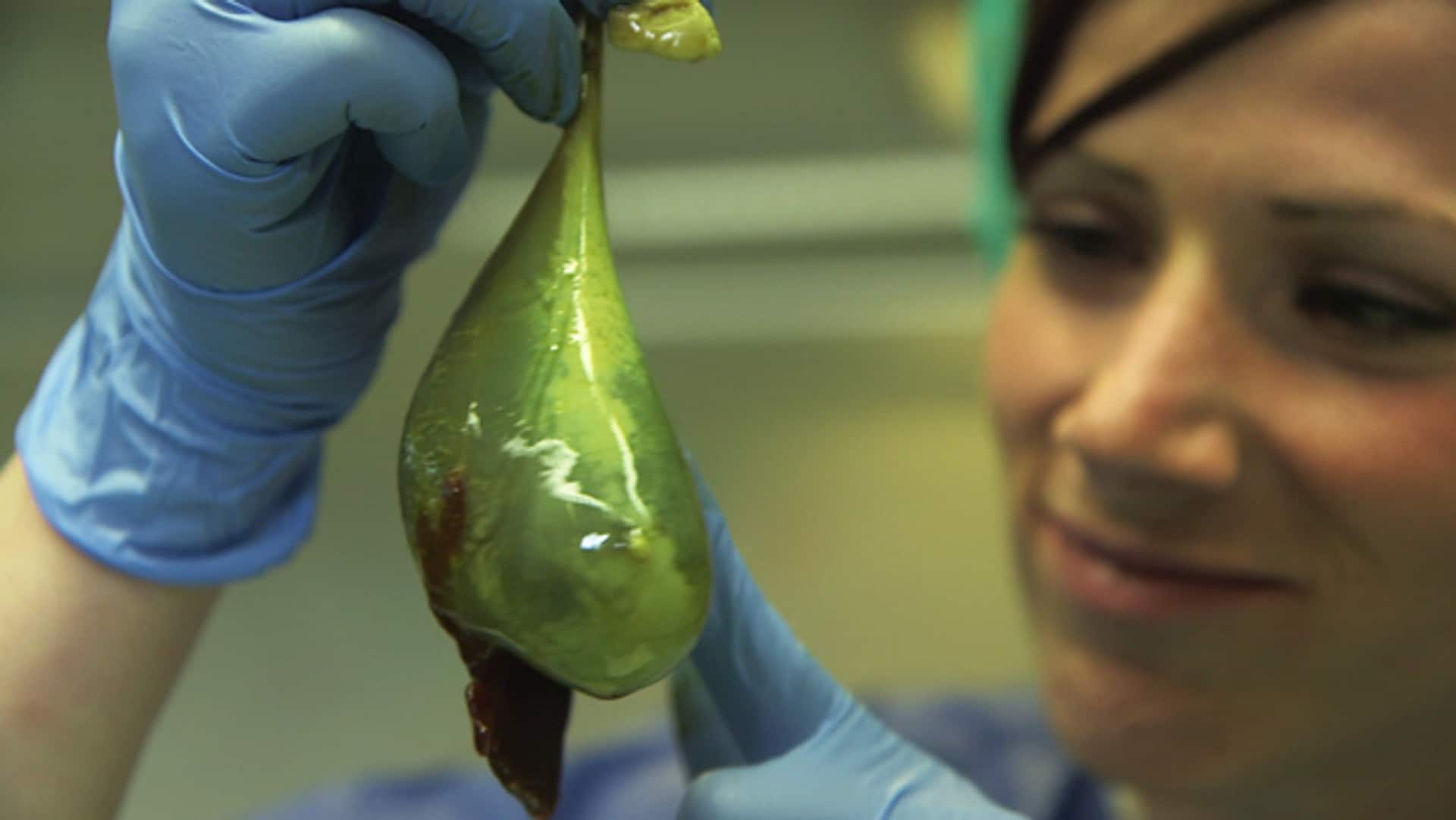 Line forteller om gallen – NRK