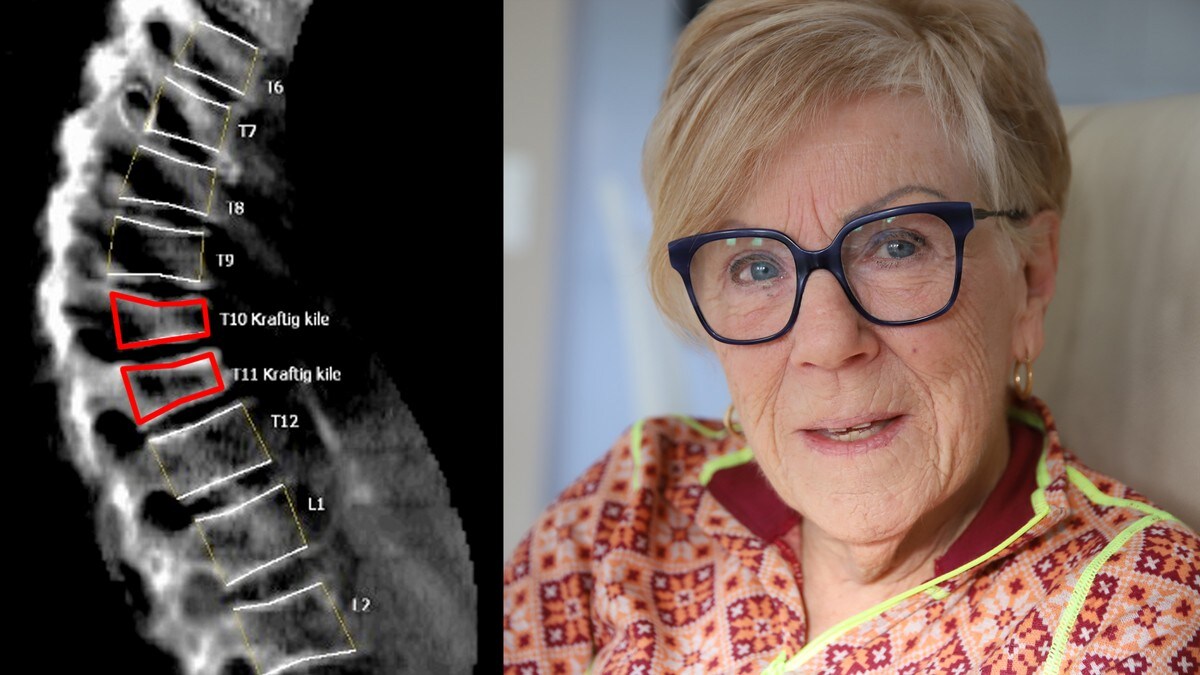Randi hadde brot i ryggen utan å vite det: – Eg fekk sjokk