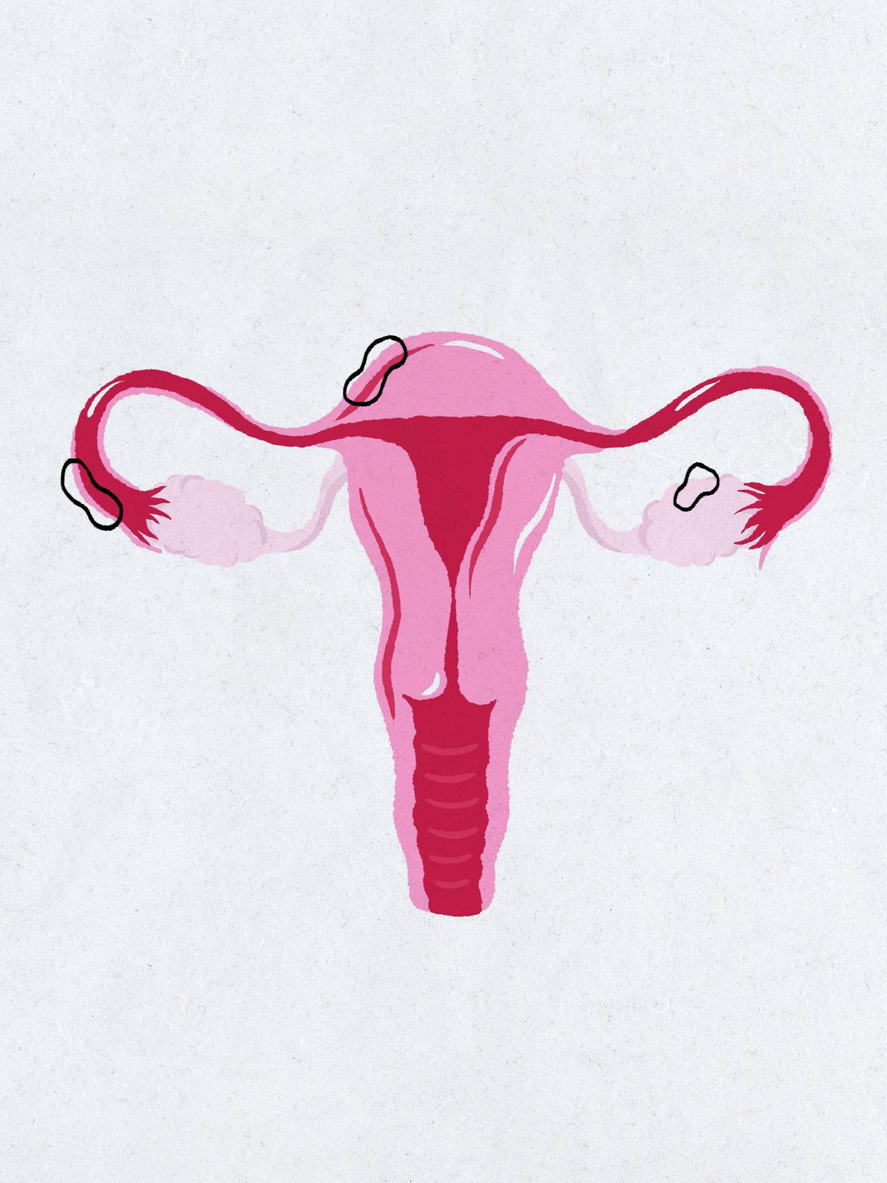 Livmor med endometriosevev