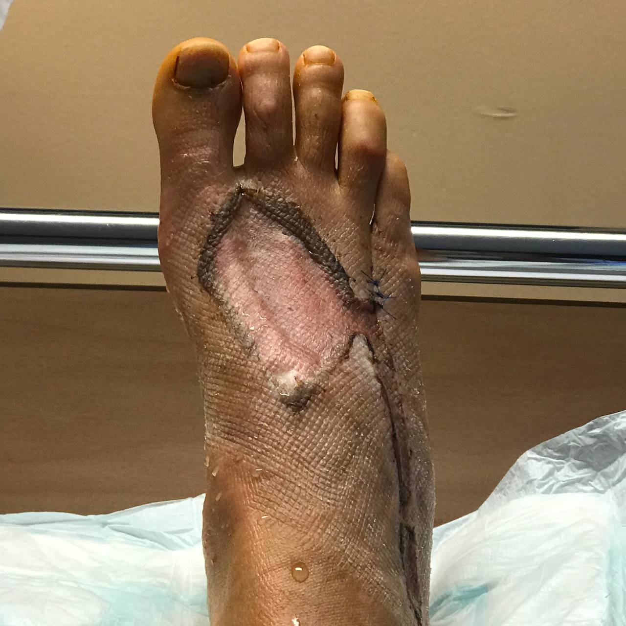 Foten til Henriette Berle Broch etter hudtransplantasjon