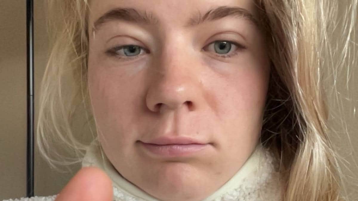 Tok test etter at øyelokkene hovnet opp – svaret satte henne ut