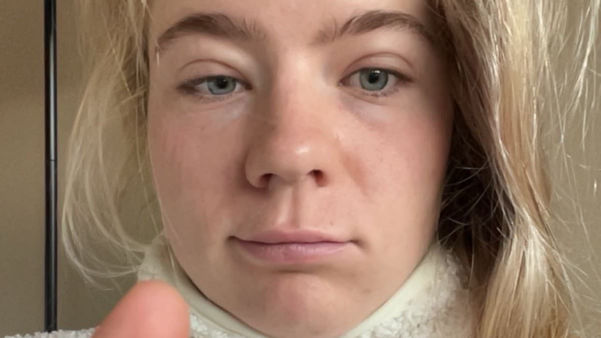 Tok test etter at øyelokkene hovnet opp – svaret satte henne ut