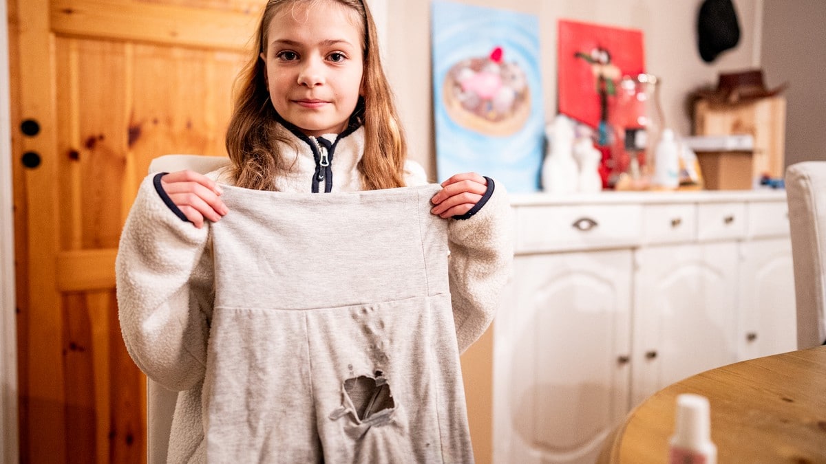 Kine (10) skulle bare lime på en negl – fikk andregradsforbrenning