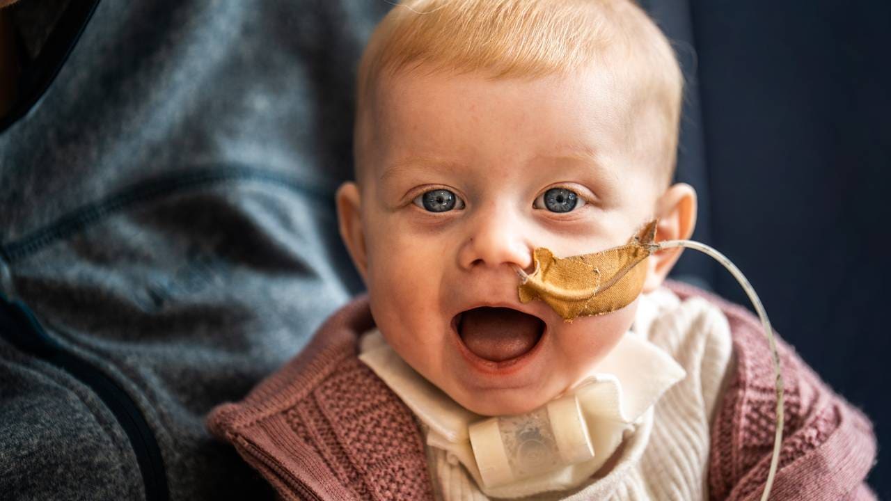 En blid, fem måneder gammel baby med sonde i nesen.