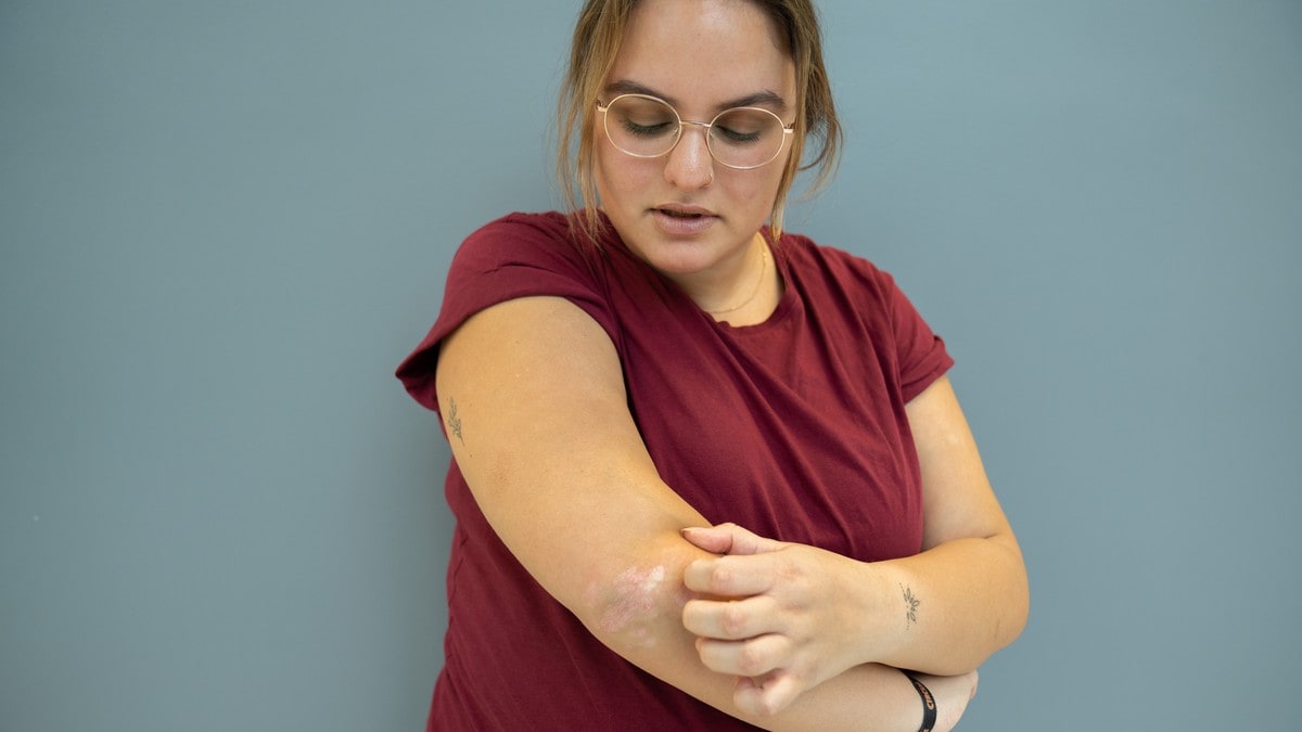 Emilie (26) lever med intens kløe. Nå er forskere nærmere et svar på hvorfor