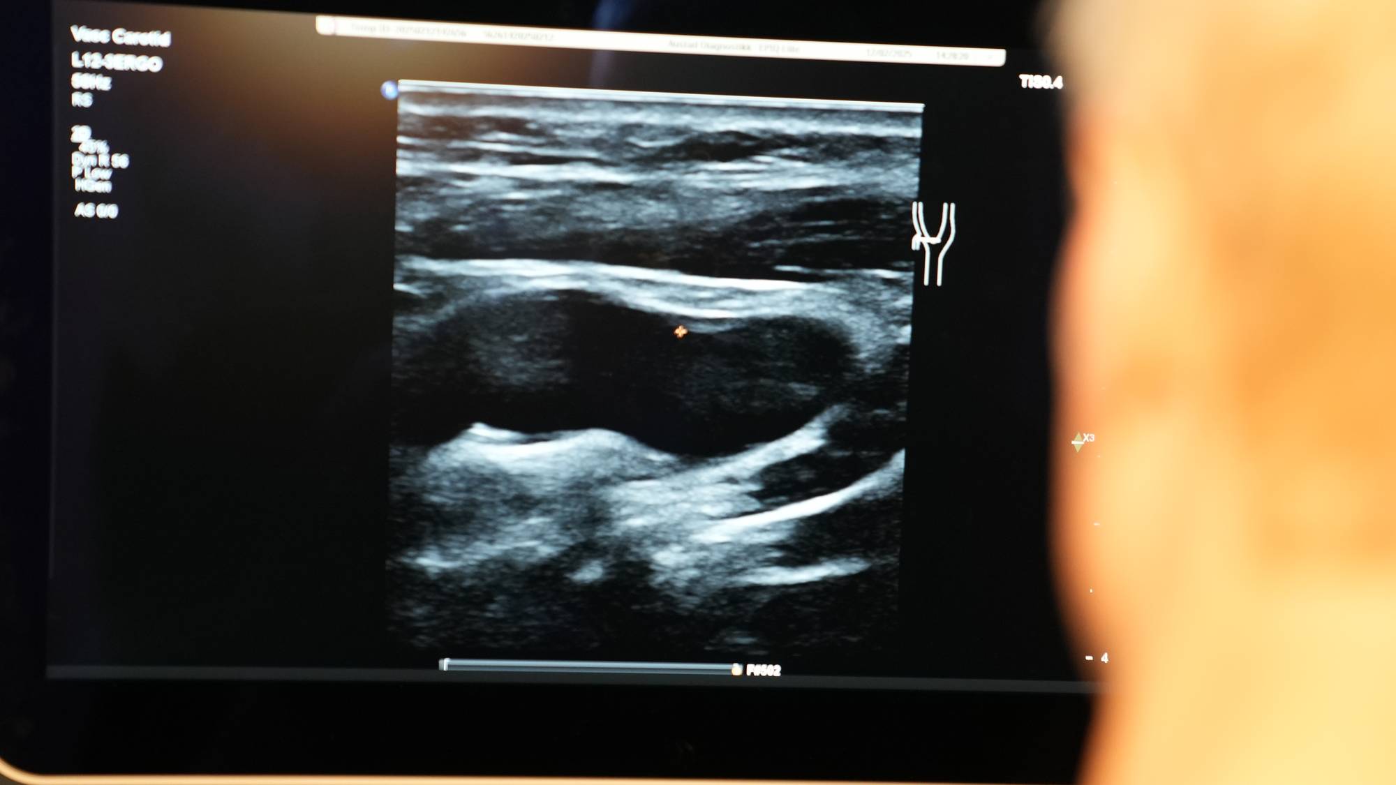 Skjermbilde av ultralyd under helsesjekk