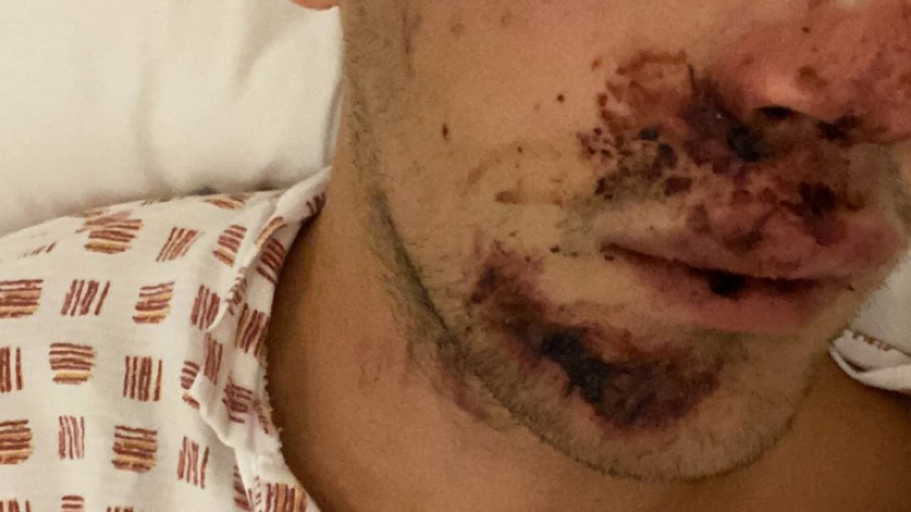 Stian Werme ble skadet etter kjøring med elsparkesykkel.