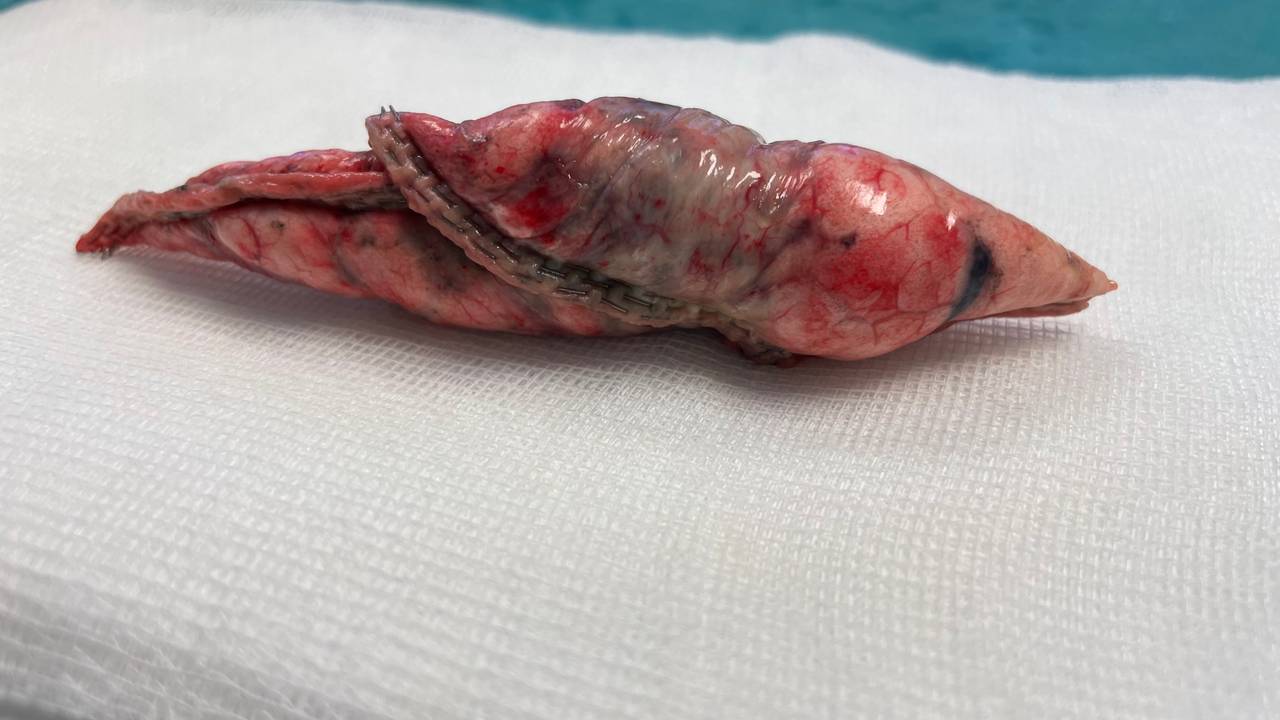 En avlang frøformet klump med endometriose og vev ligger på et hvitt håndkle på et bord på operasjonsrommet. Klumpen er spiss i begge ender rødlig og svartflekkete. 