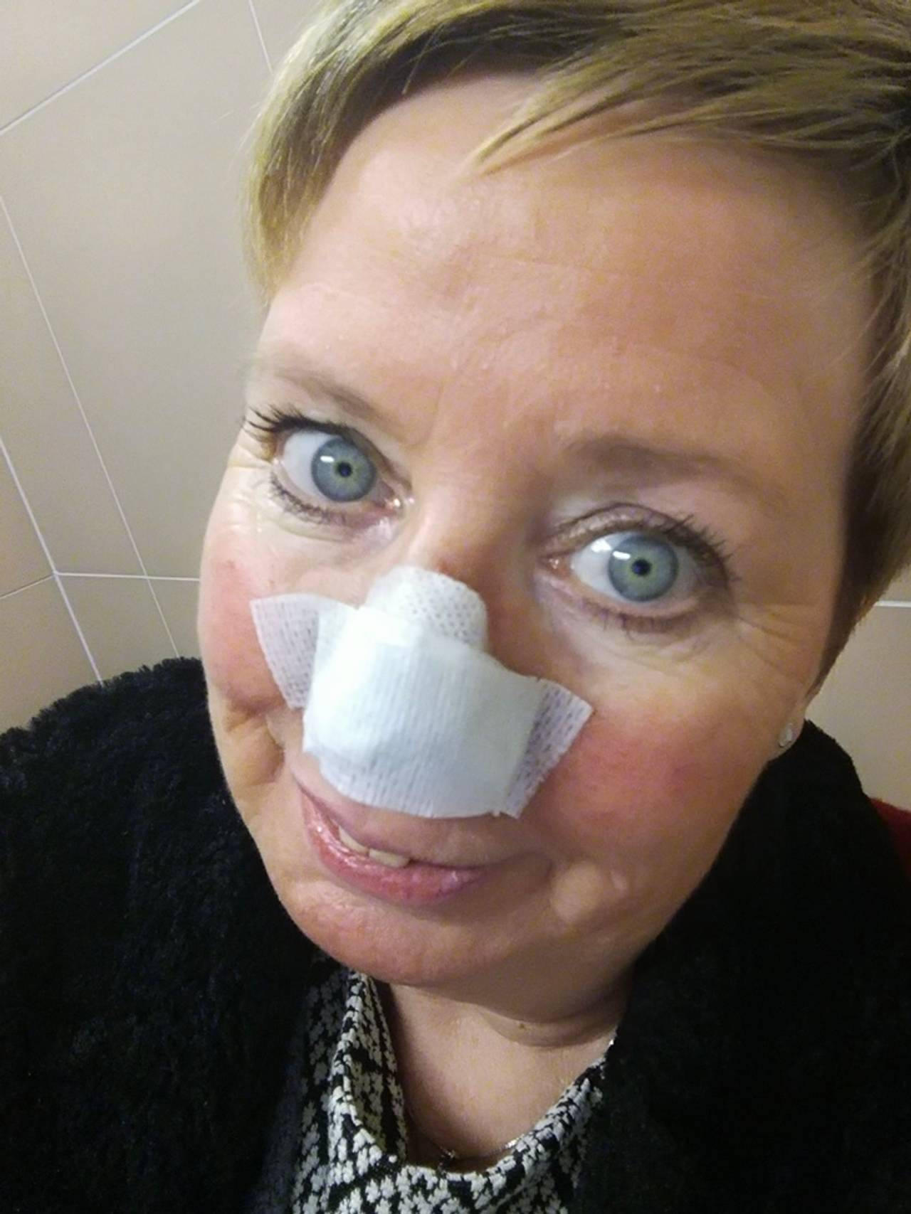 Monica Johansen med plaster på nesen etter å ha fått kreft