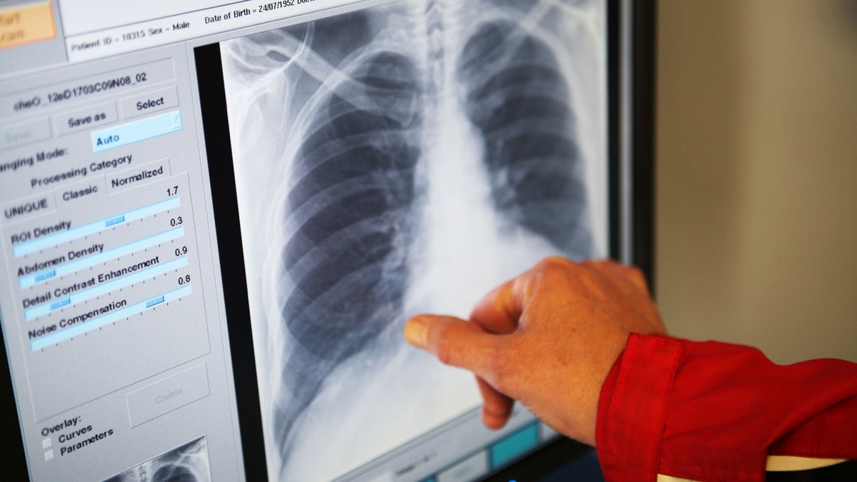 Tillitsvalgte krever kompensasjon etter røntgenskandale
